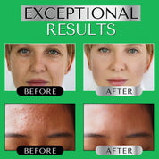 Before and after of retinol users, showing improvements in skin texture and tone with acne, hyperpigmentation and blemishes reduced.